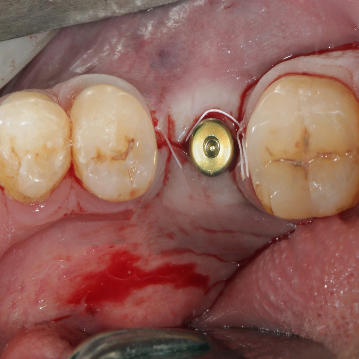 implants implants